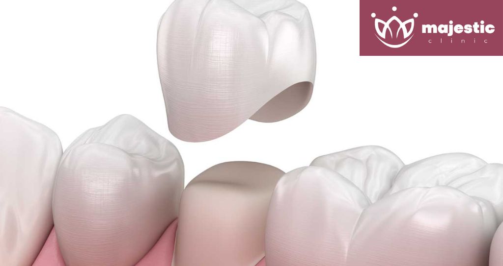 Dental Crowns 1 Dental Crowns Clinic in Istanbul, Turkey | Porcelain Crowns Istanbul - Majestic Clinic Smile